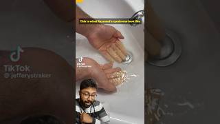 Raynauds phenomenon doctor reaction medical [upl. by Eachern]