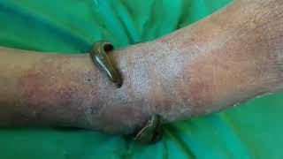 Leech Therapy in Palmoplantar Psoriasis by Dr Bijendra Shah [upl. by Delphina]