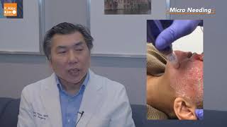 Microneedling with PRP or without PRP by Alex Kim MD [upl. by Bilski]