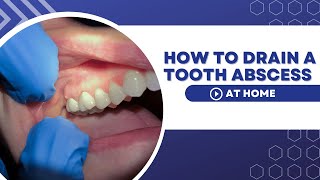 How To Drain A Tooth Abscess At Home Using Home Remedies [upl. by Lynus]