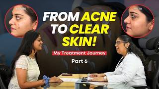 What Really Happens During Acne Treatment My Journey to Clear Skin Part 6  Clear Skin Pune [upl. by Leiruh]