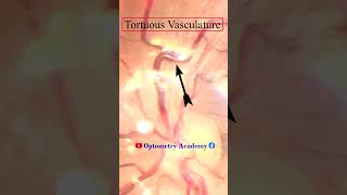 Tortuous Retinal vessels  Fundus Photography  Short Video 107 optometry optometrist [upl. by Irish]