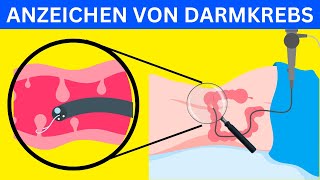 7 Warnzeichen von Darmkrebs Was Sie wissen müssen [upl. by Kho142]