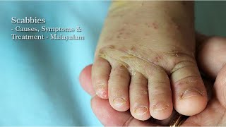 Scabies Causes Symptoms Treatment amp Prevention Tips  Malayalam [upl. by Andrien403]