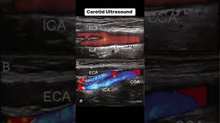 Carotid Ultrasound [upl. by Cita]