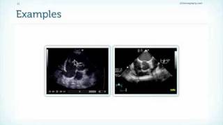 Tricuspid Valve Endocarditis in Echocardiography [upl. by Etheline]