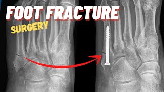 FIXING A FIFTH METATARSAL FRACTURE  Jones Fracture  Dr Nick Campitelli [upl. by Jareb]