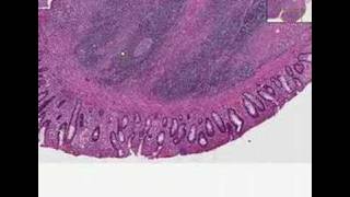 Histopathology ColonUlcerative colitis carcinoma atypia [upl. by Magocsi]