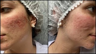 3ª Sessão do Microagulhamento para cicatrizes de acne  Dermapen [upl. by Engracia]