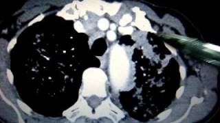 CT scans  Lung cancer [upl. by Bili858]