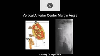 MRI of the Hip Part 1 – Hip AVN [upl. by Fawcette234]