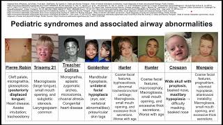 Pediatric syndromes and associated airway abnormalities [upl. by Mandy]