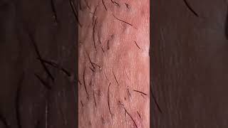 Hair Removalsatisfying asmr facial beautiful beautiful beautytips haircare [upl. by Arde]