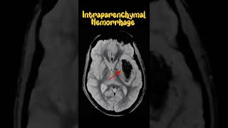 Intraparenchymal hemorrhage  MRI BRAIN GRE Sequence hemorrhage brain mri radiology [upl. by Rao892]