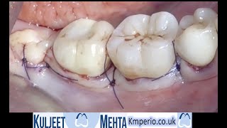 Periodontal surgery Lower right molars [upl. by Anar]