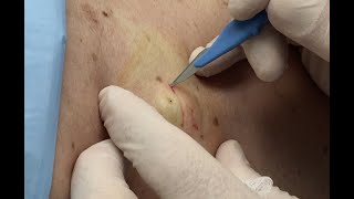 Gambit Part 1 AbscessCyst Treatment Dr Gilmores Birthday [upl. by Euqinay390]