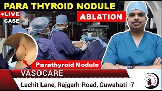 Para Thyroid Nodule ABLATION  LIVE CASE  Dr Arup Karmakar drarupkarmakar1492 [upl. by Iadrahc887]