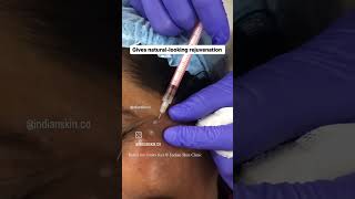 Botox for crows feet  treatment for wrinkles around eyes botox crowsfeet nagpurskinclinic [upl. by Sialac344]