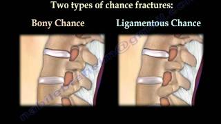 Chance Fractures of the Spine  Everything You Need To Know  Dr Nabil Ebraheim [upl. by Aivat]