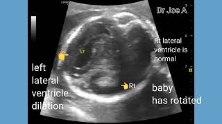 Mild unilateral dilation lateral ventricle in fetus unilateral ventriculomegaly ultrasound video [upl. by Sosna]