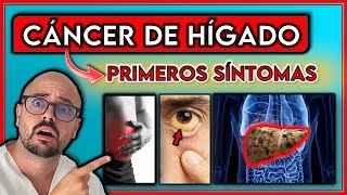 ESTOS son los 7 PRIMEROS SÍNTOMAS del CÁNCER DE HÍGADO  ¡No IGNORES estos SÍNTOMAS [upl. by Giamo]