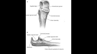 Olecranon Osteotomy Approach [upl. by Sobmalarah]