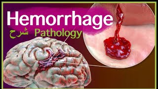 Pathology  Hemorrhage  Blood Hemodynamic disorders شرح باثو [upl. by Byler]