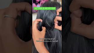 Shocking results of Antidandruff Oil  Before after  Vilvah  For The Real You [upl. by Thurmann]