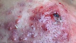 CYSTIC ACNE REMOVAL  Inflammatory Acne Acne Skin Treatment [upl. by Anirac482]