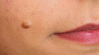 Indepartarea alunitelor fara cicatrici  Radiofrequency removal of facial nevus [upl. by Intosh3]