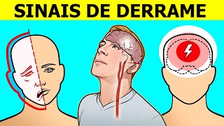 6 SINAIS QUE UM DERRAME CEREBRAL ESTA A CAMINHO [upl. by Neelhsa]