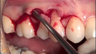 CV50 Treatment of single moderate gingival recessions PREVIEW [upl. by Ynafets]