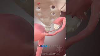 Ectopic Pregnancy drmuhammedziya pregnancy ectopicpregnancy doctor discover women [upl. by Gennie]