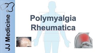 Polymyalgia Rheumatica  Signs amp Symptoms Diagnosis and Treatment [upl. by Borchert]