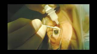 KERATOCONUS TREATMENT CORNEAL COLLAGEN CROSSLINKING C3R  NIO Pune [upl. by Notneuq]