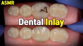 Dental Inlay Procedure [upl. by Meraree579]