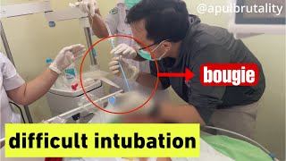 Bougie assisted endotracheal intubation  difficult intubation [upl. by Asus785]