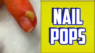 Top 4 Paronychia amp Nail Infections of All Time [upl. by Ahcirt]