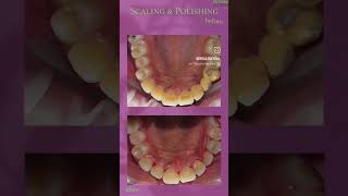 Teeth cleaning  scaling polishing dentistteeth dentalclinic dentist [upl. by Georglana]