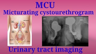 MCU Procedure  Micturating Cystourethrogram  Urinary tract imaging  By BL Kumawat [upl. by Keyes]