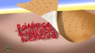 Painless bandage removal [upl. by Alage]