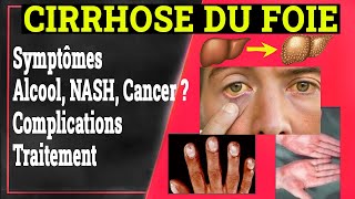 Cirrhose du foie symptômes et fibrose du foie [upl. by Nahseez]