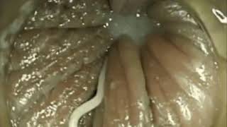 Enterobius vermicularisPinworm Infection [upl. by Constancia]