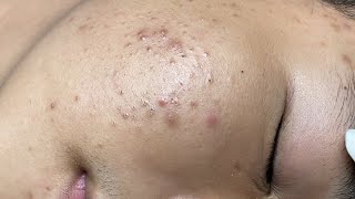 ACNE TREATMENT VU QUYNH MI Acne On Boys Chin 2024 [upl. by Strephon496]