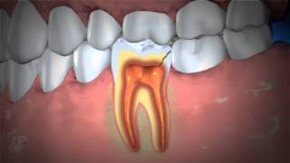 Treatment of Abscessed Teeth [upl. by Kelvin]