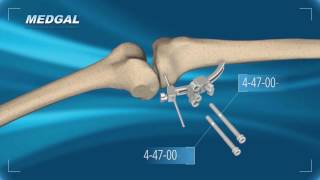 Tibial Osteotomy TECHNIQUE [upl. by Kruger]