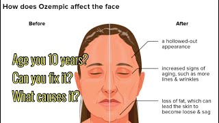 Ozempic Face What Causes It Is It Body Dysmorphia Mounjaro Ozempic Zepbound Wegovy Semaglutide [upl. by Gibbons938]