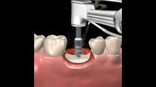 Step by step dental implant surgery Gary R OBrien DDS [upl. by Aerol]