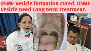 OSMF Vesicle formation cured OSMF Vesicle need Long term treatment amp follow Patient result after Tt [upl. by Nelan296]