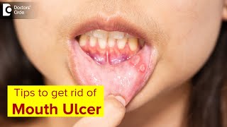 Mouth Ulcer Mouth Sores Symptoms Treatment amp Prevention MethodsDrLahari ASR  Doctors Circle [upl. by Narih]